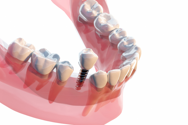 インプラント費用内訳のイメージ図