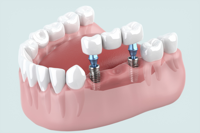 ブリッジ治療のイメージ図